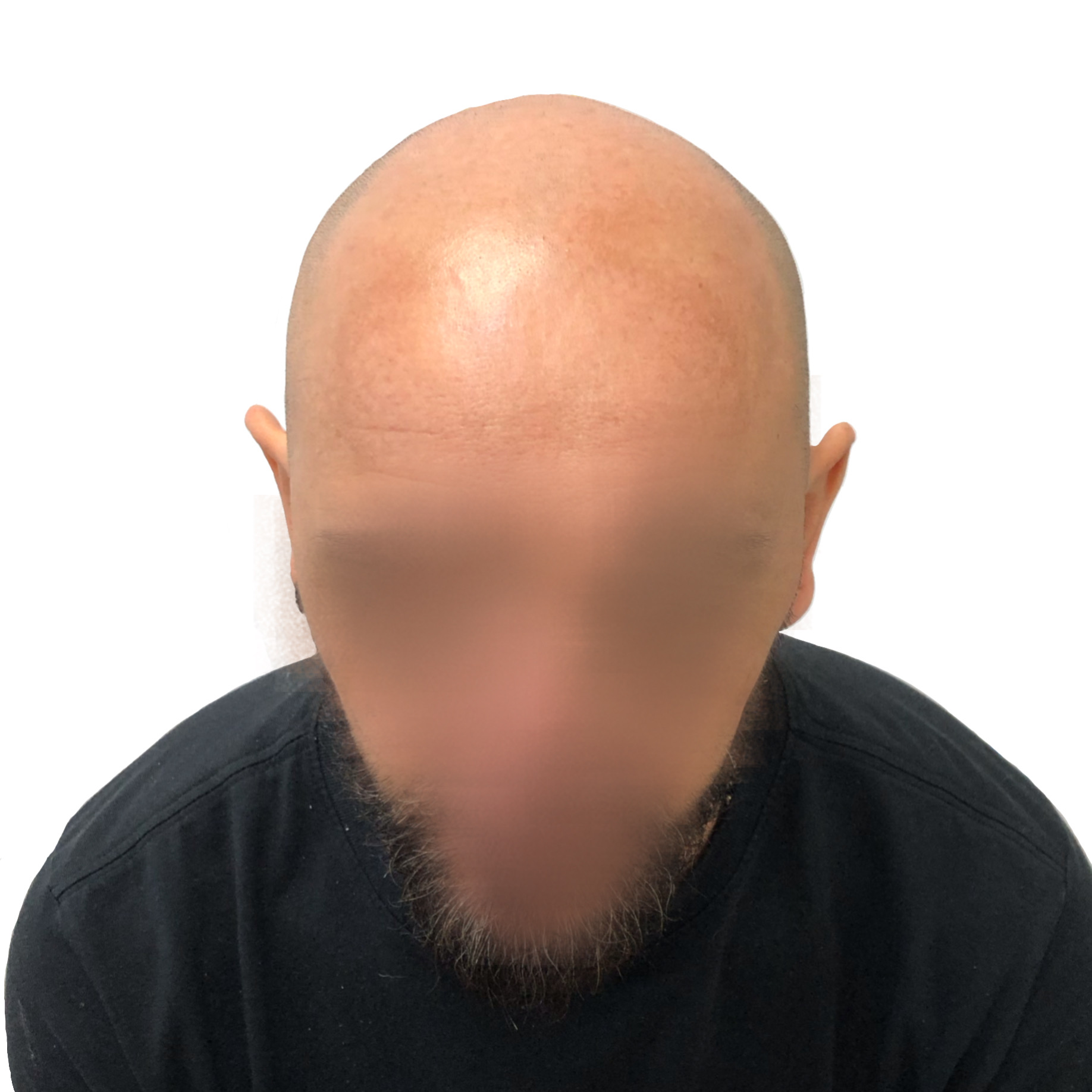 Antes